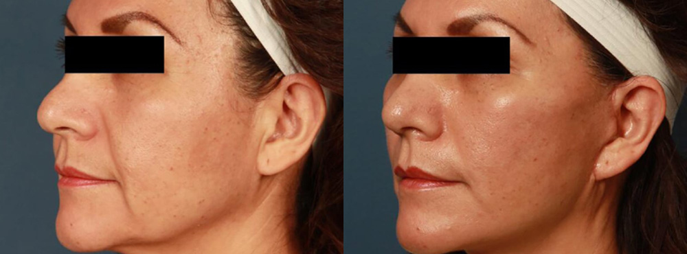 Face Lift Before and After