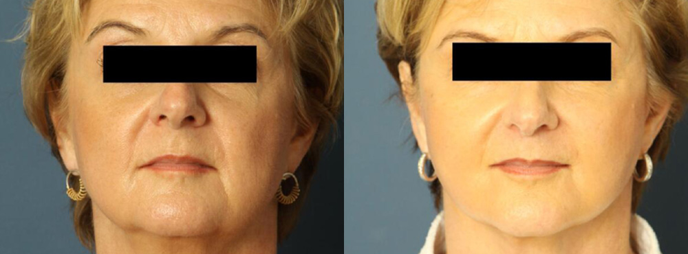 Face Lift Before and After in Miami