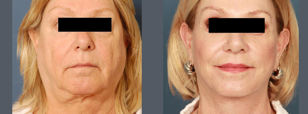 Face Lift Before and After