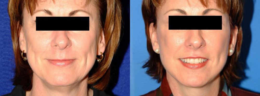 Face Lift Before and After in Miami