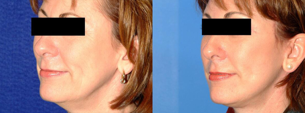 Face Lift Before and After in Miami