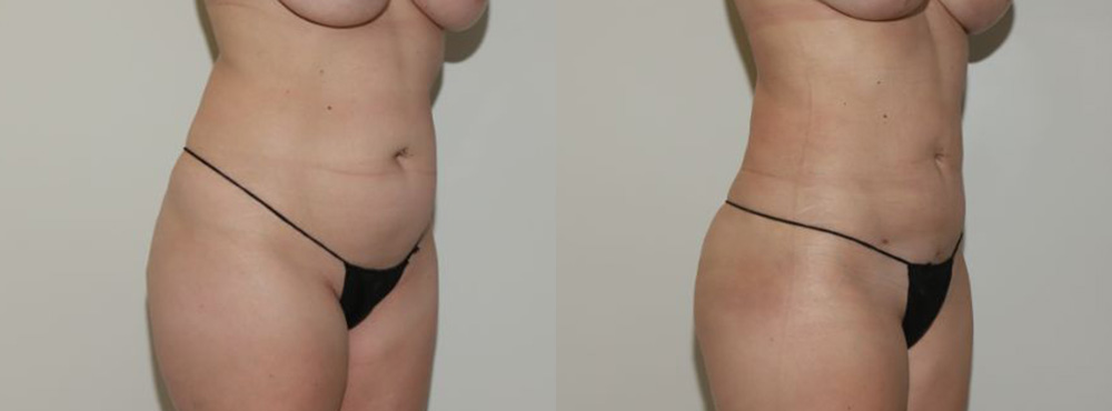 Liposuction Before and After 