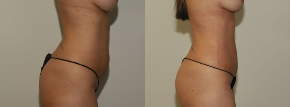 Liposuction Before and After