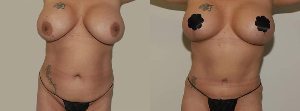 Mommy Makeover Before and After