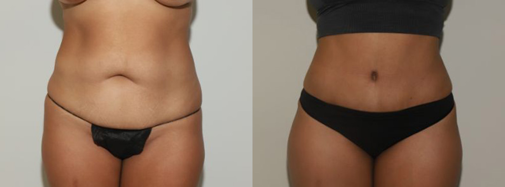 Tummy Tuck Before and After in Miami