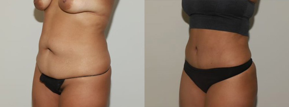 Tummy Tuck Before and After in Miami