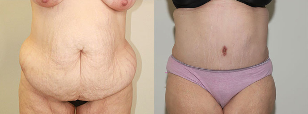 Tummy Tuck Before and After