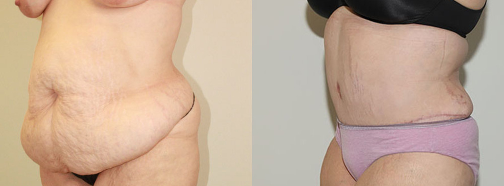 Tummy Tuck Before and After