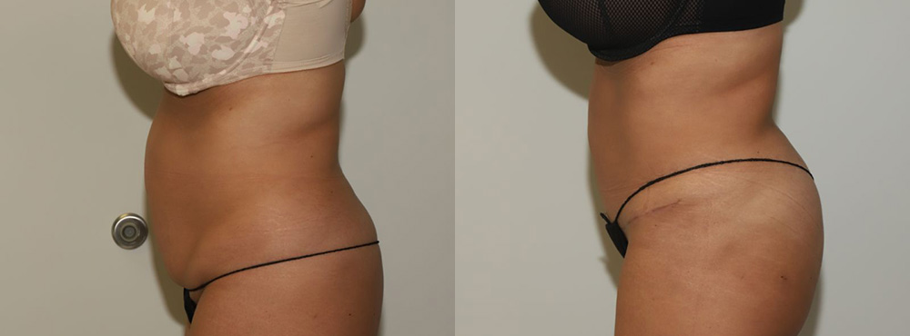 Tummy Tuck Before and After