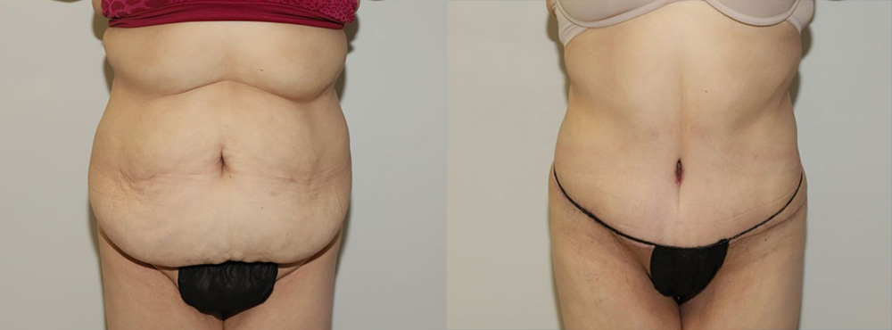 Tummy Tuck Before and After