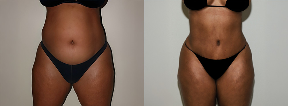 Tummy Tuck Before and After in Miami