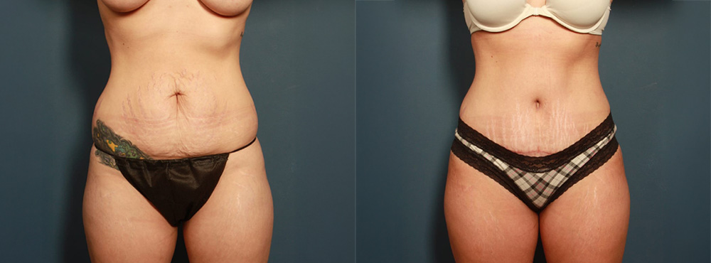 Tummy Tuck Before and After in Miami