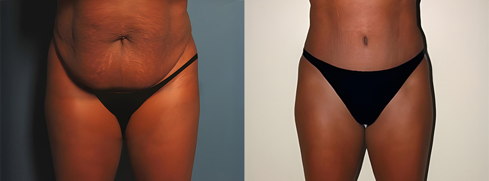 Tummy Tuck Before and After in Miami