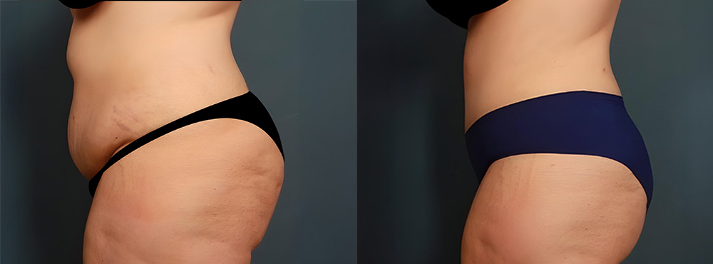 Tummy Tuck before and after