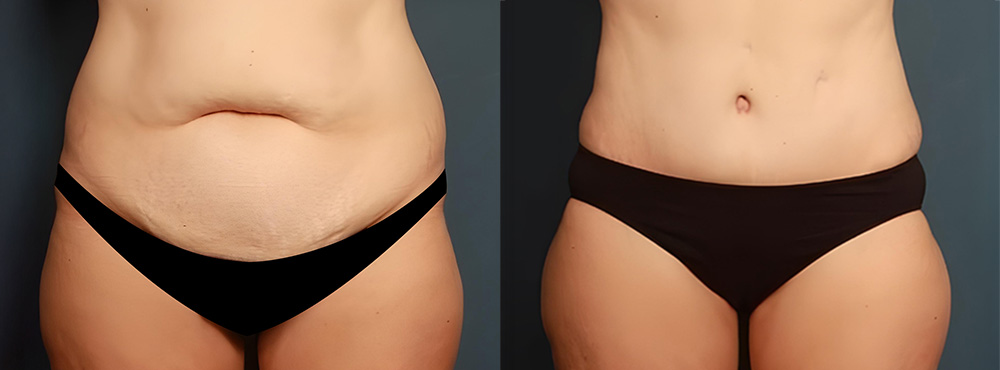Tummy Tuck Before and After