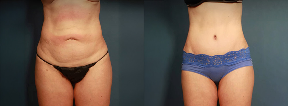 Tummy Tuck before and After
