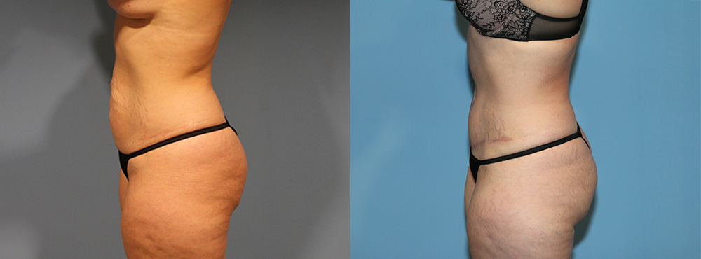 Tummy Tuck Before and After