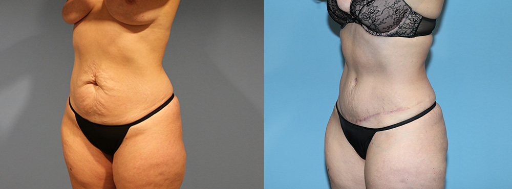 Tummy Tuck Before and After