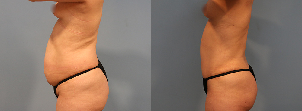 Tummy Tuck Before and After