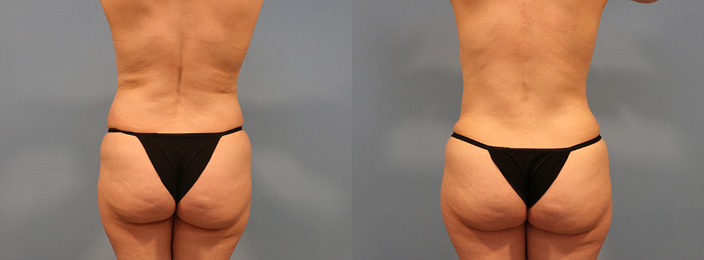 Tummy Tuck Before and After