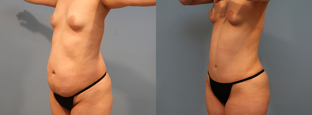Tummy Tuck Before and After