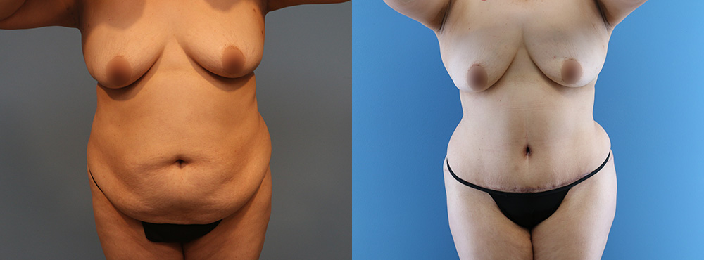 Tummy Tuck Before and After