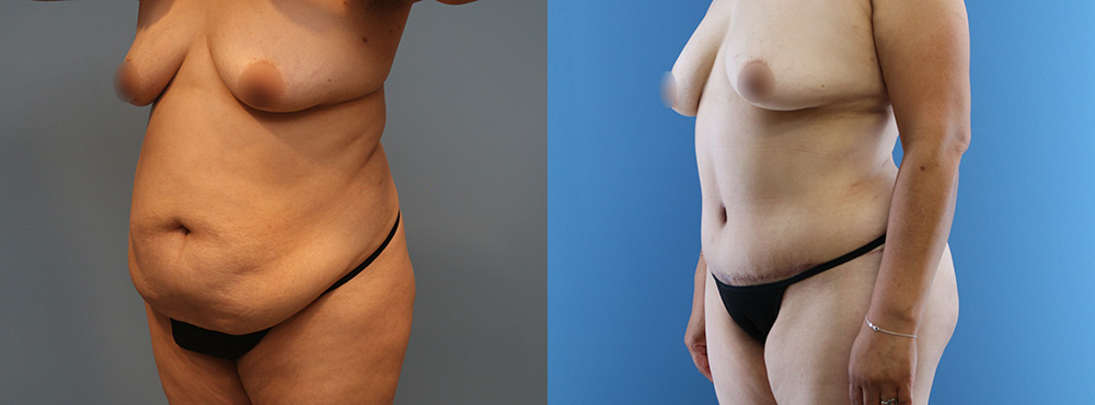 Tummy Tuck Before and After