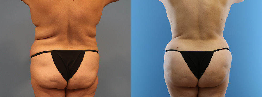 Tummy Tuck Before and After