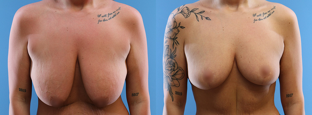 Breast Lift Before and After