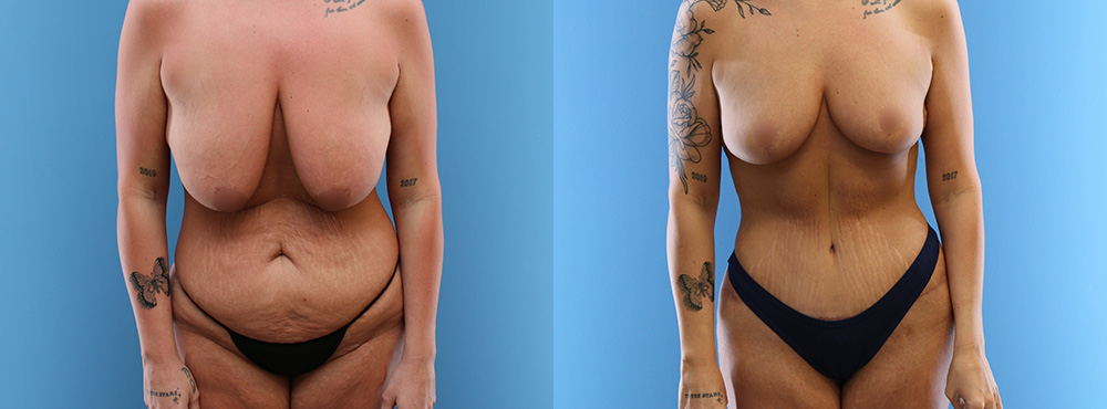 Mommy Makeover Before and After