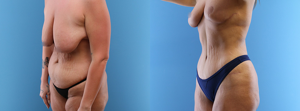 Mommy Makeover Before and After