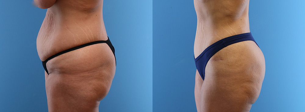 tummy Tuck Before and after