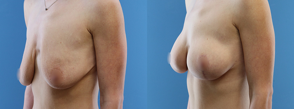 Breast Lift Before and After