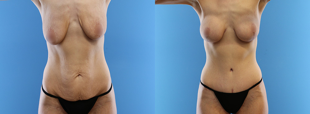 Mommy Makeover Before and After