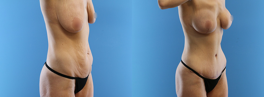 Mommy Makeover Before and After