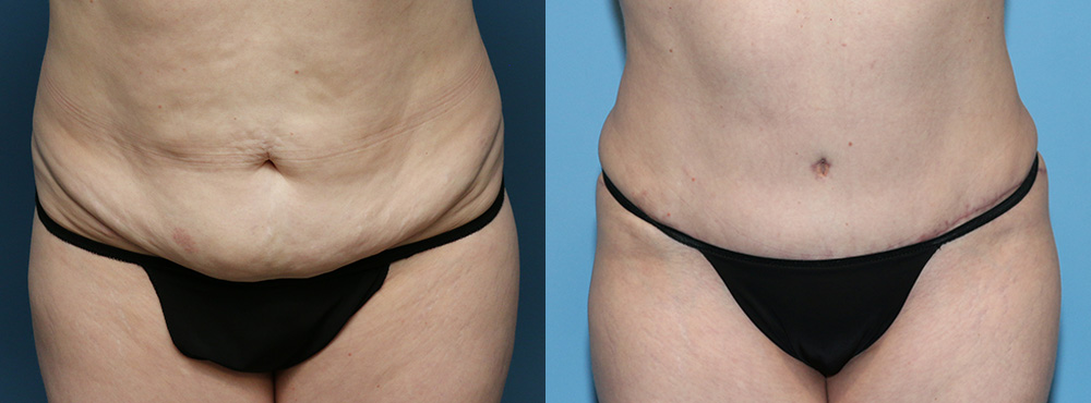 Tummy Tuck Before and After