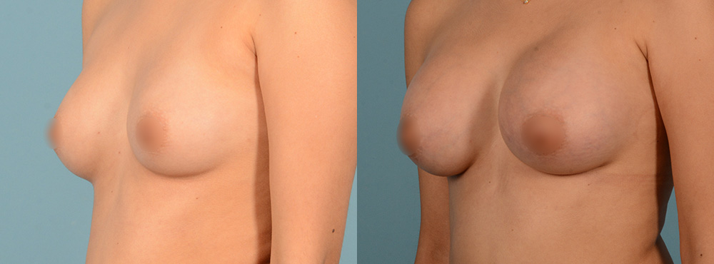 Breast Augmentation before and after