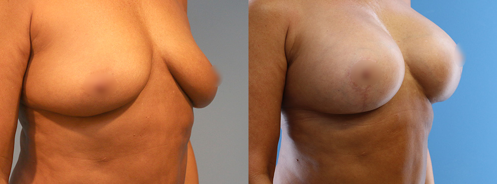 Breast Lift Before and after