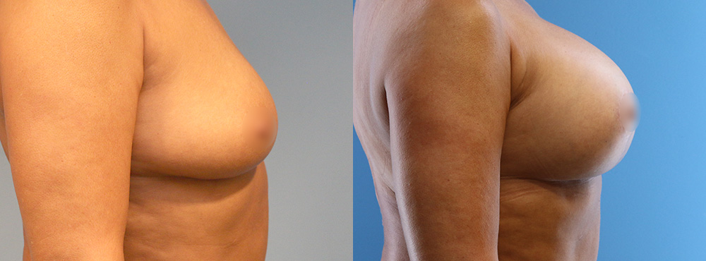 Breast Lift Before and after
