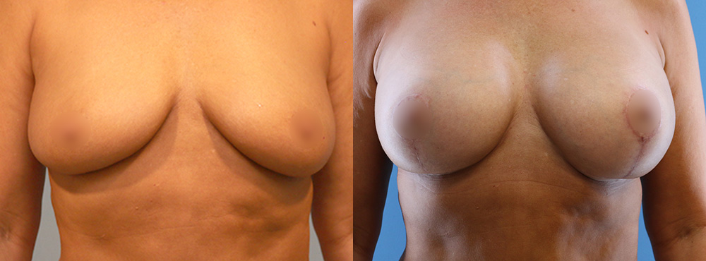 Breast Lift Before and after