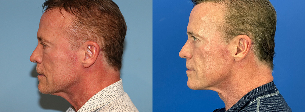 Neck Lift Before And After
