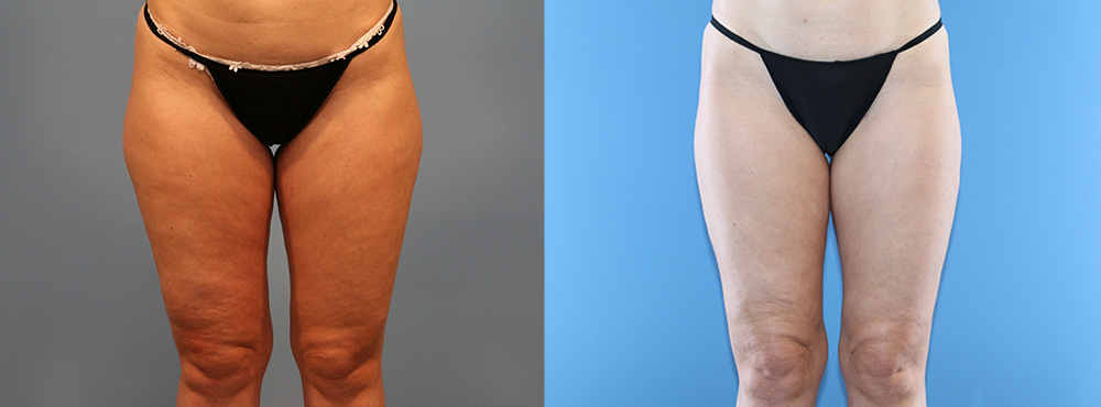 Thigh Lift Before and After