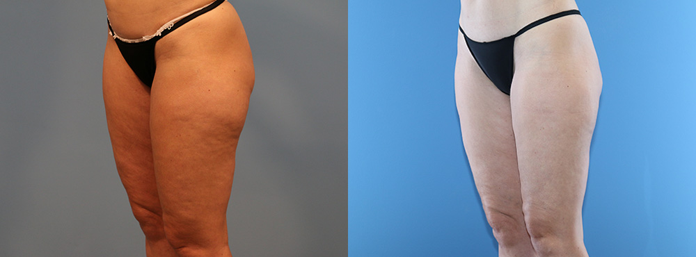 Thigh Lift Before and After