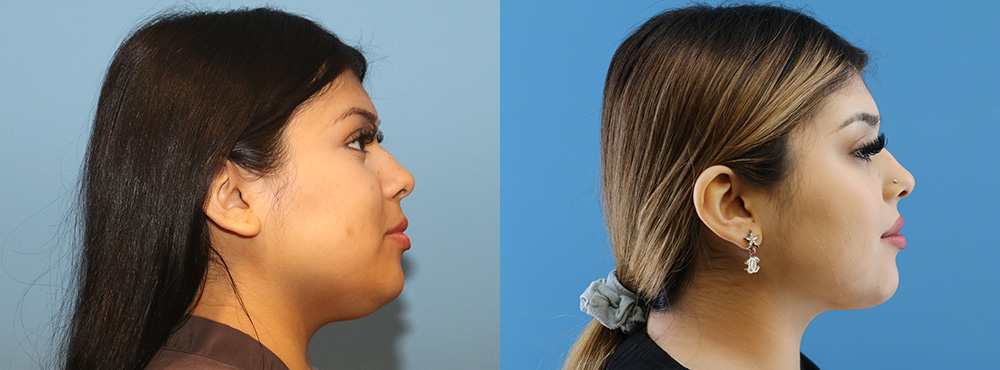 Chin Lipo Before and After