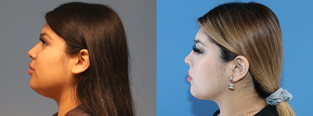 Chin Lipo Before and After