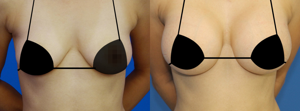 Breast Augmentation Before and After in Miami