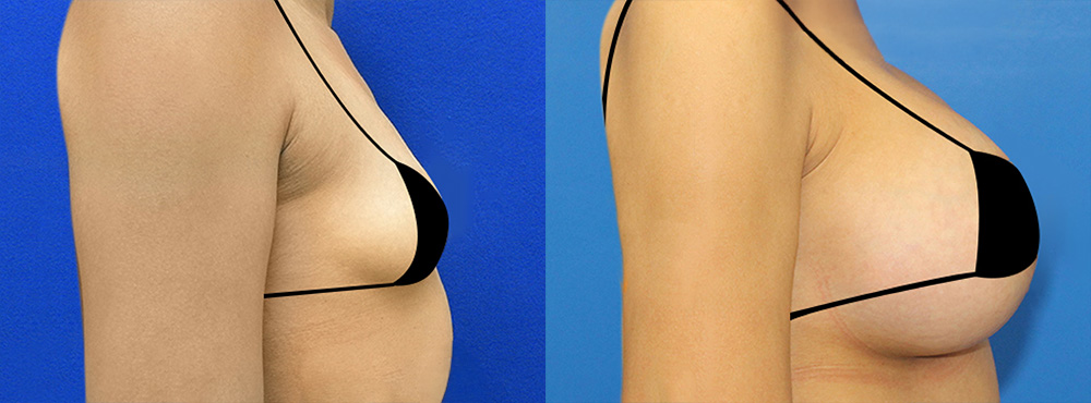 Breast Augmentation Before and After in Miami