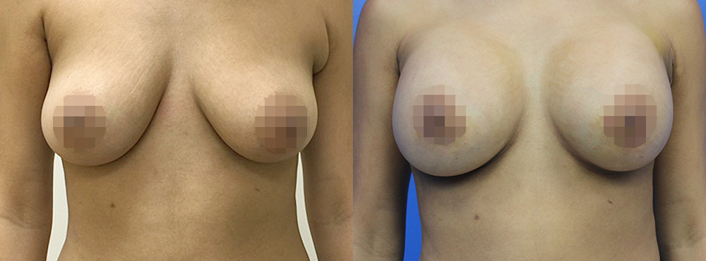 Breast Augmentation Before and After