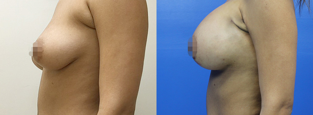 Breast Augmentation Before and After