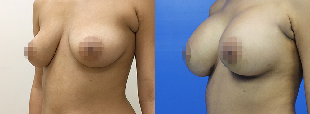 Breast Augmentation Before and After